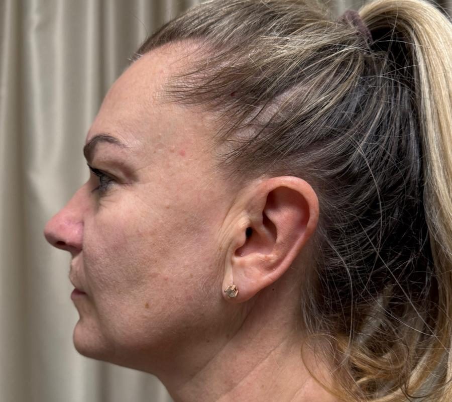 Pleť po ošetrení v Identity Beauty Lounge