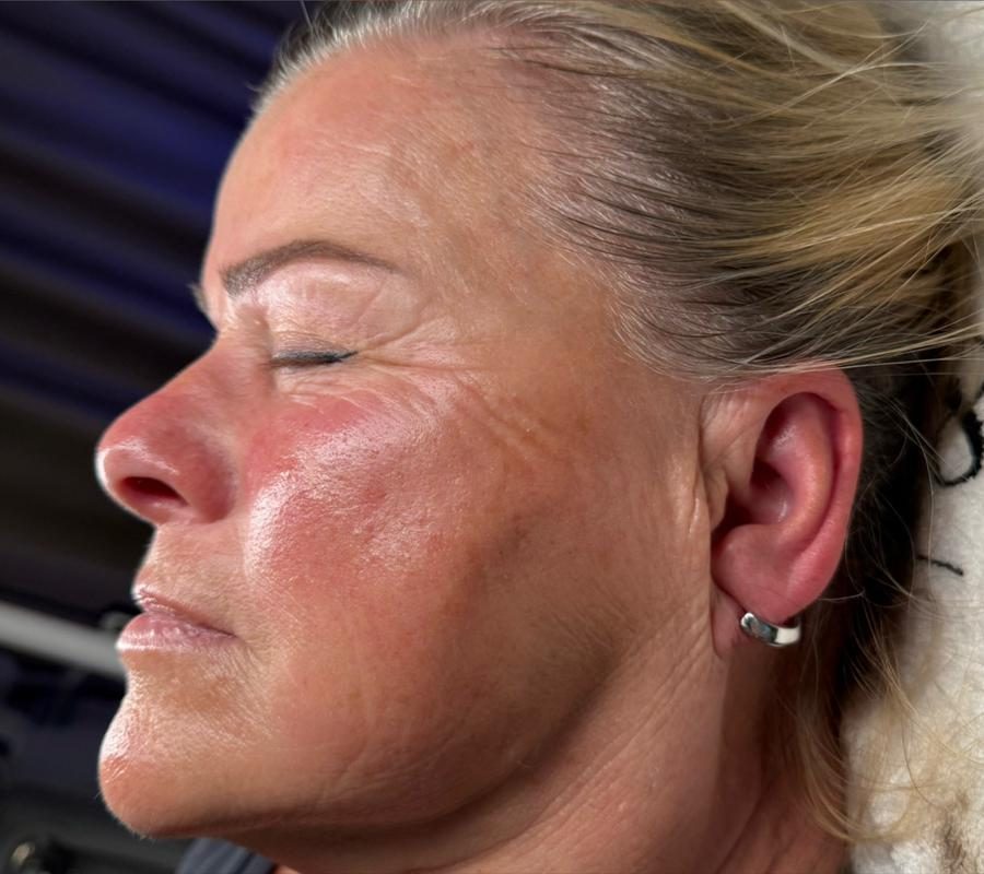 Pleť po ošetrení v Identity Beauty Lounge