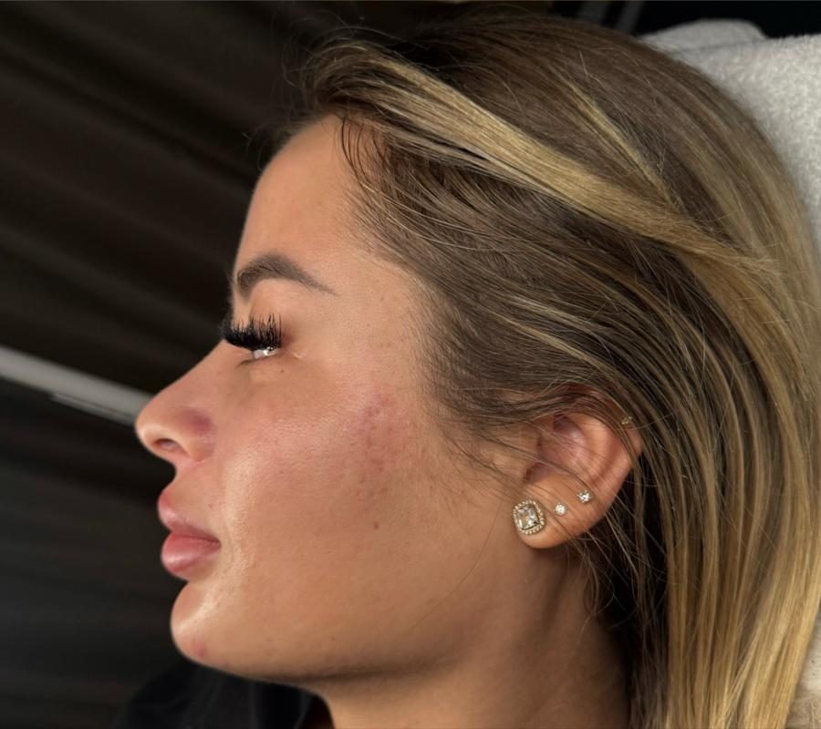 Pleť po ošetrení v Identity Beauty Lounge