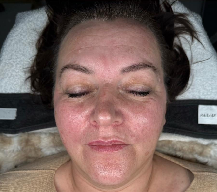 Pleť po ošetrení v Identity Beauty Lounge