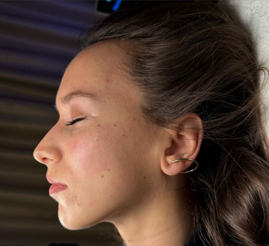 Pleť po ošetrení v Identity Beauty Lounge