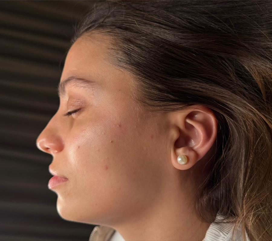 Pleť po ošetrení v Identity Beauty Lounge